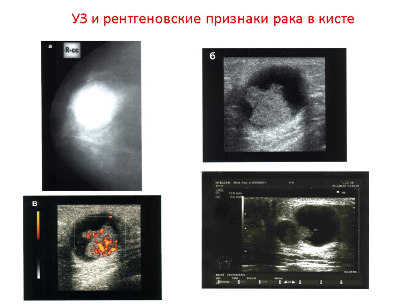 УЗ и рентгеновские признаки рака в кисте